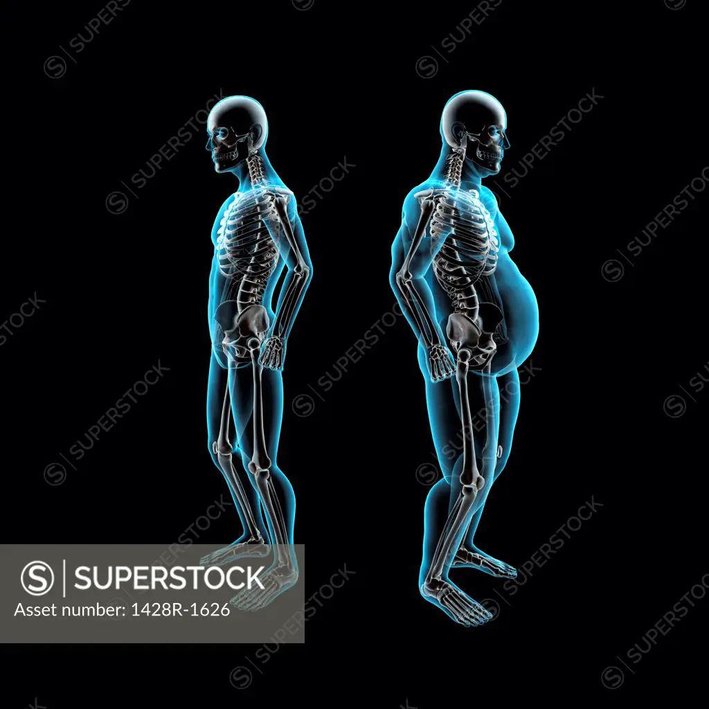 Thin and obese men back to back, X-ray image - SuperStock