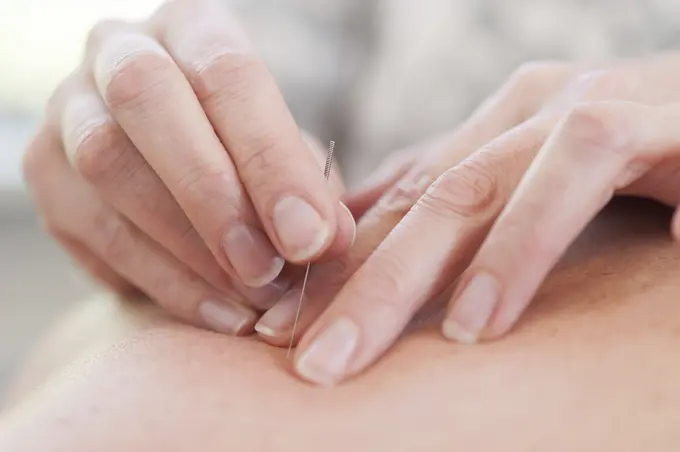 Acupuncturist inserting acupuncture needles into patient's skin