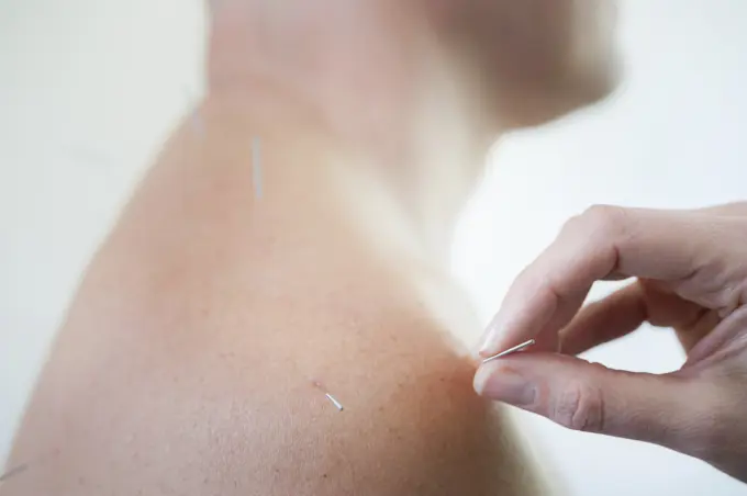 Acupuncturist inserting acupuncture needles into patient's skin