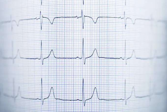 Healthy electrocardiogram