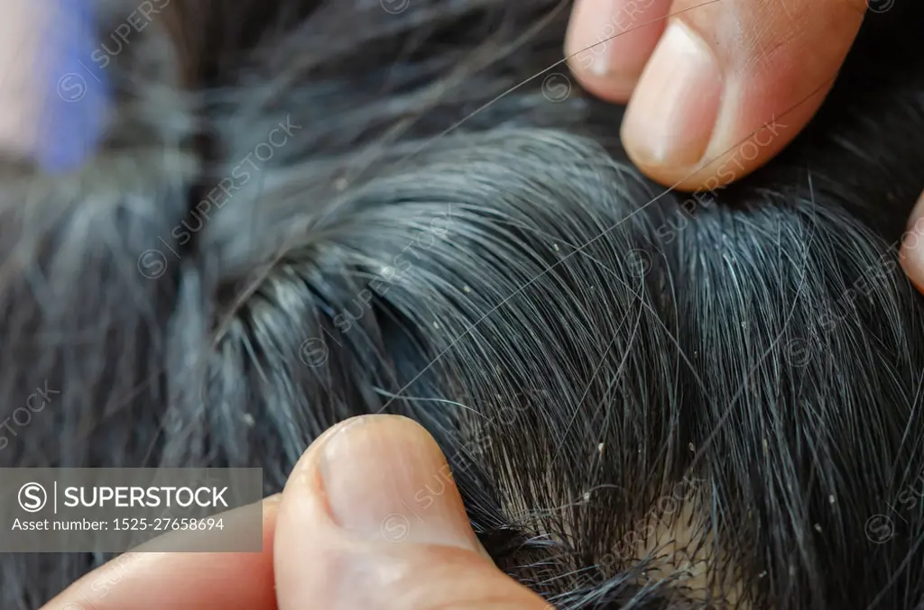 Louse egg on the hair causes itchy head.