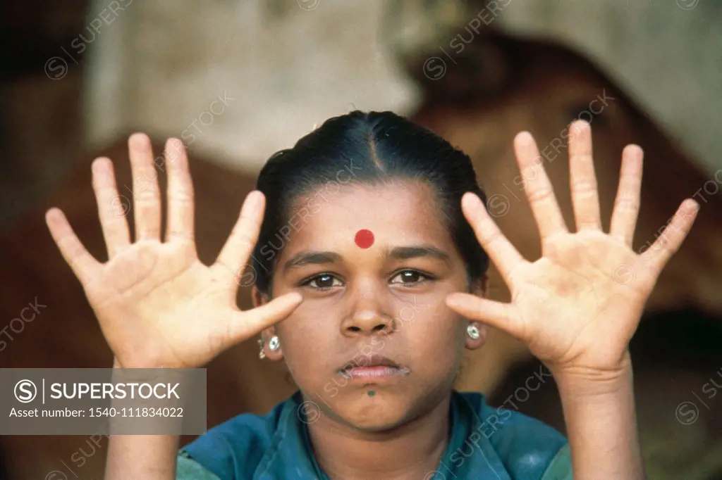 woman with six fingers to hand , india