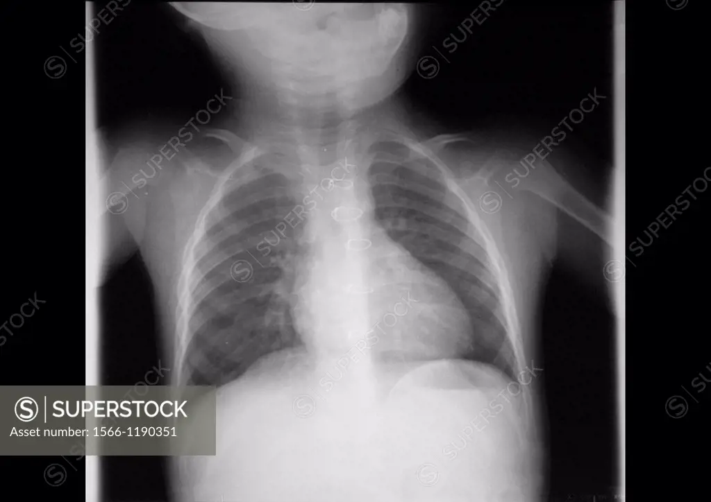 Lung X ray of a young child having had a heart surgery