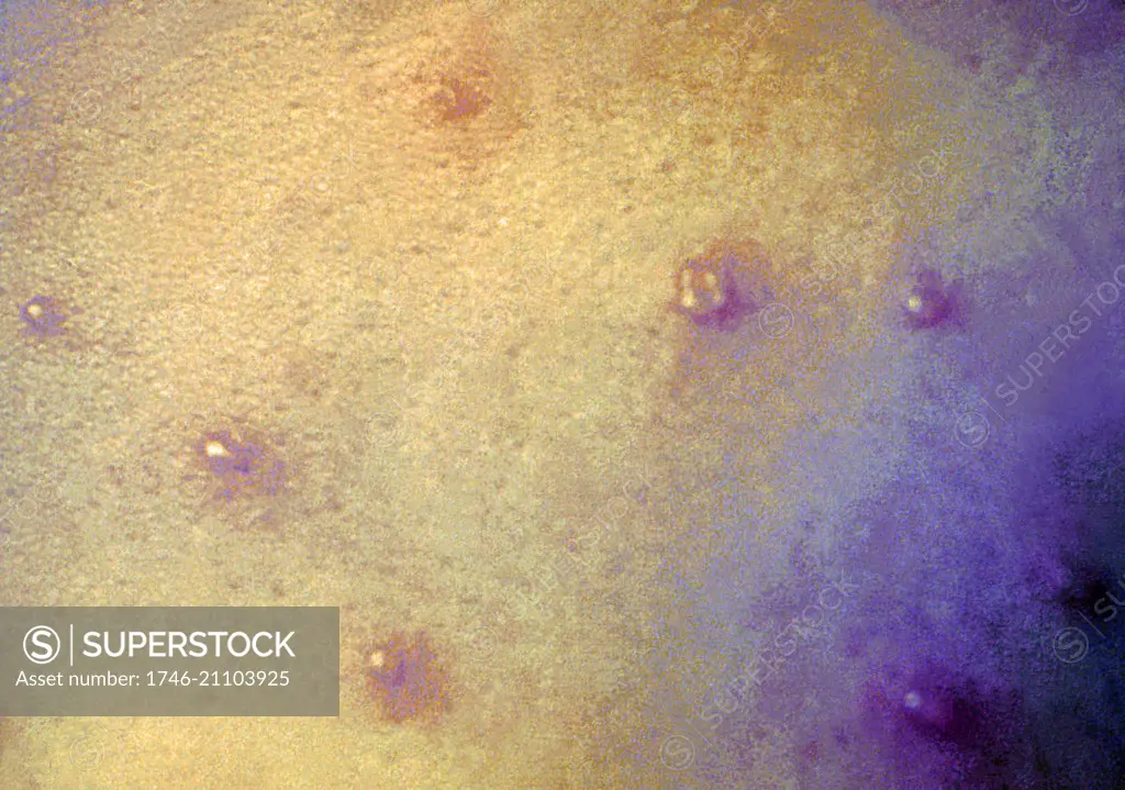 A close-up of a maculopapular rash, diagnosed as chickenpox lesions. Anyone who hasn't had chickenpox or received the chickenpox vaccine can get the disease. The classic symptom of chickenpox is a rash that turns into itchy, fluid-filled blisters that eventually turn into scabs.