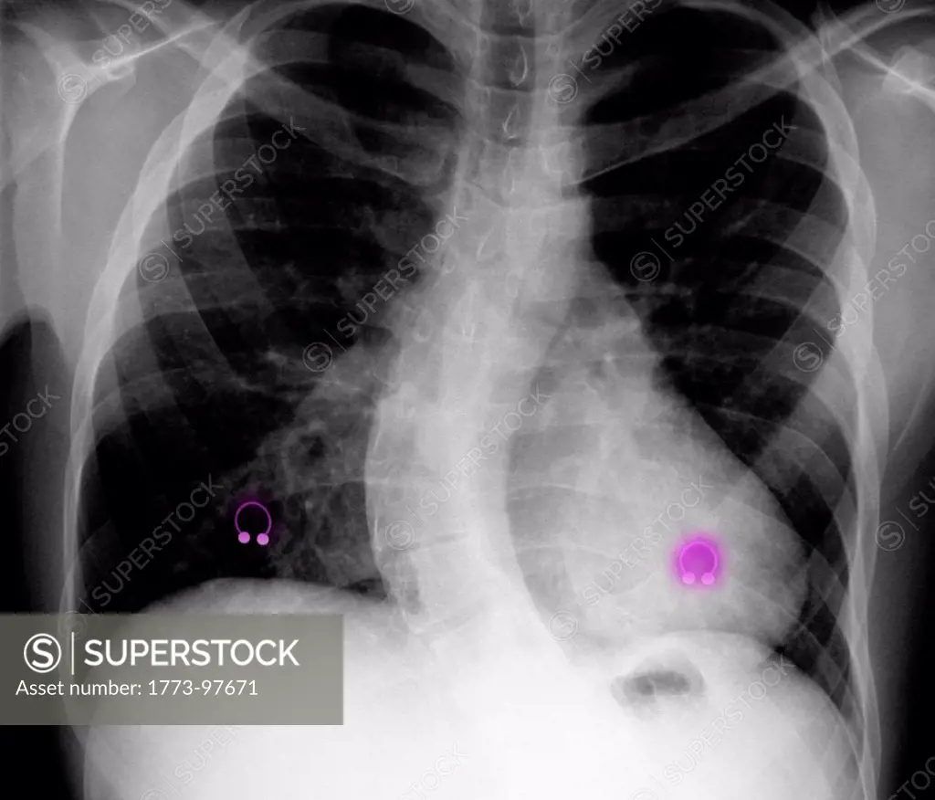 Chest X-ray showing scoliosis and nipple piercings