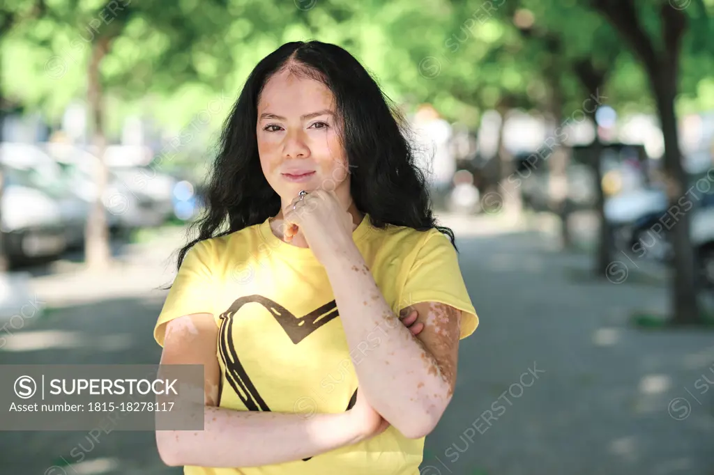 Young woman with vitiligo standing outdoors