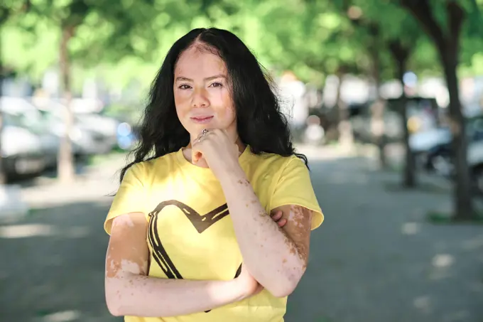 Young woman with vitiligo standing outdoors