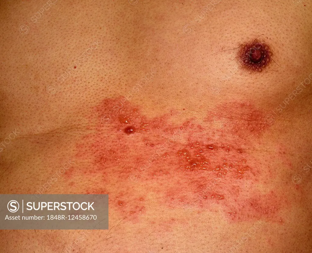 Shingles or herpes zoster in the chest area of a man, 56 years, several dermatomes or skin areas affected