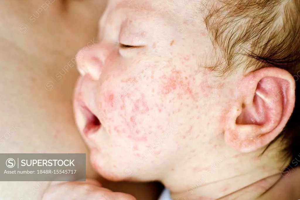 Newborn baby boy face with many red pimples caused by atopic dermatitis, Poland