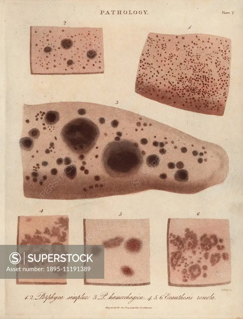 Skin diseases: Purple spots, Purpura simplex and P. haemorrhagica and rose rash, Exanthesis roseola. Handcoloured copperplate stipple engraving by Joh...