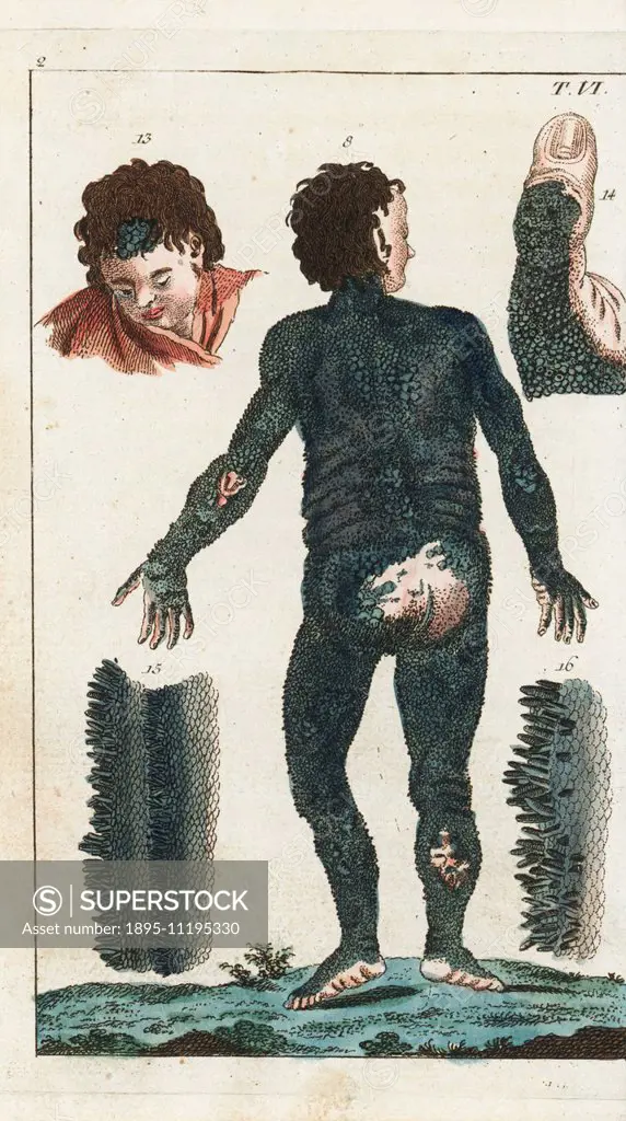 Englishman Richard Lambert (13) exhibited his porcupine skin disorder, Ichthyosis hystrix, in Leipzig. Richard was a descendent of Edward Lambert, who...