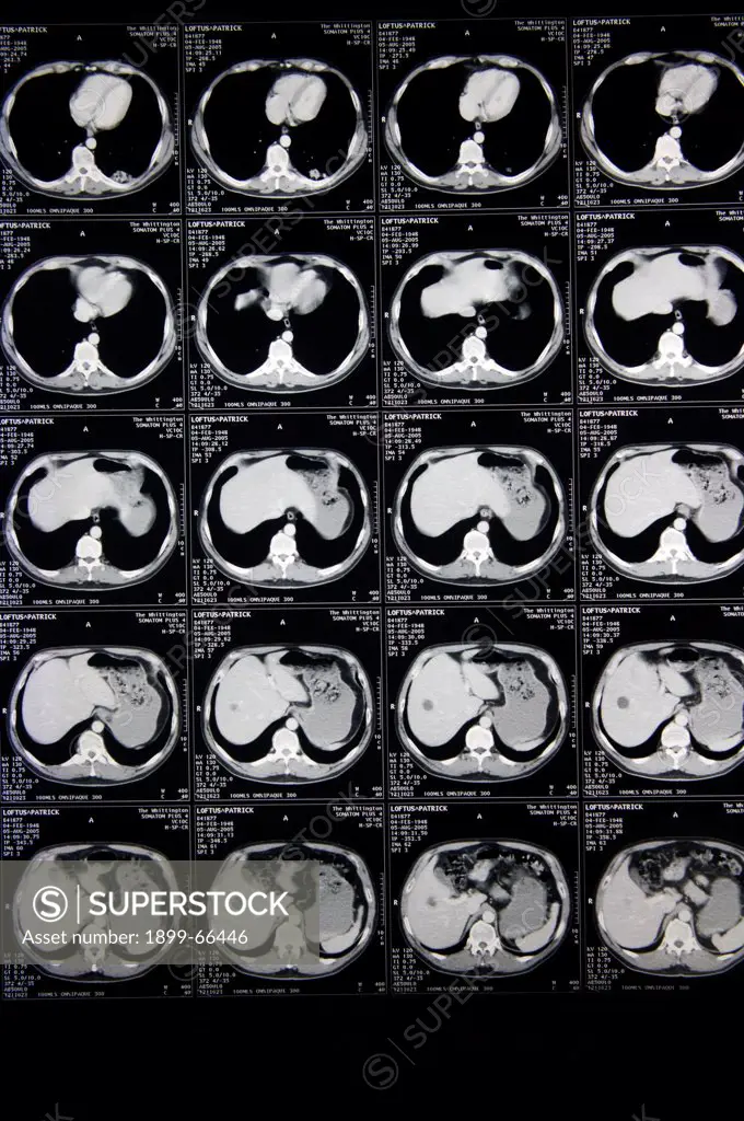 The MRI Scans made upon cerebral cortex