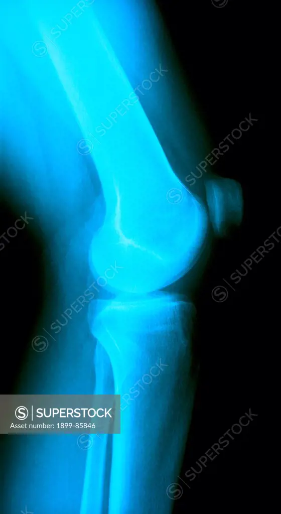 Knee X Ray