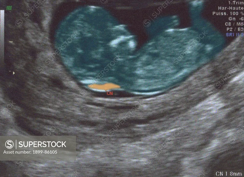 Fetus Ultrasound Scan