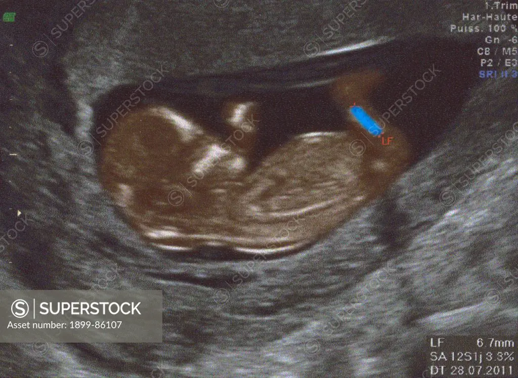 Fetus Ultrasound Scan