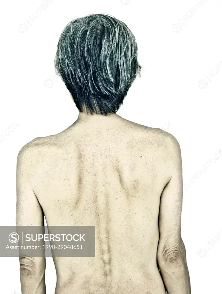 69 year old asian man, nude torso, cancer survivor - SuperStock