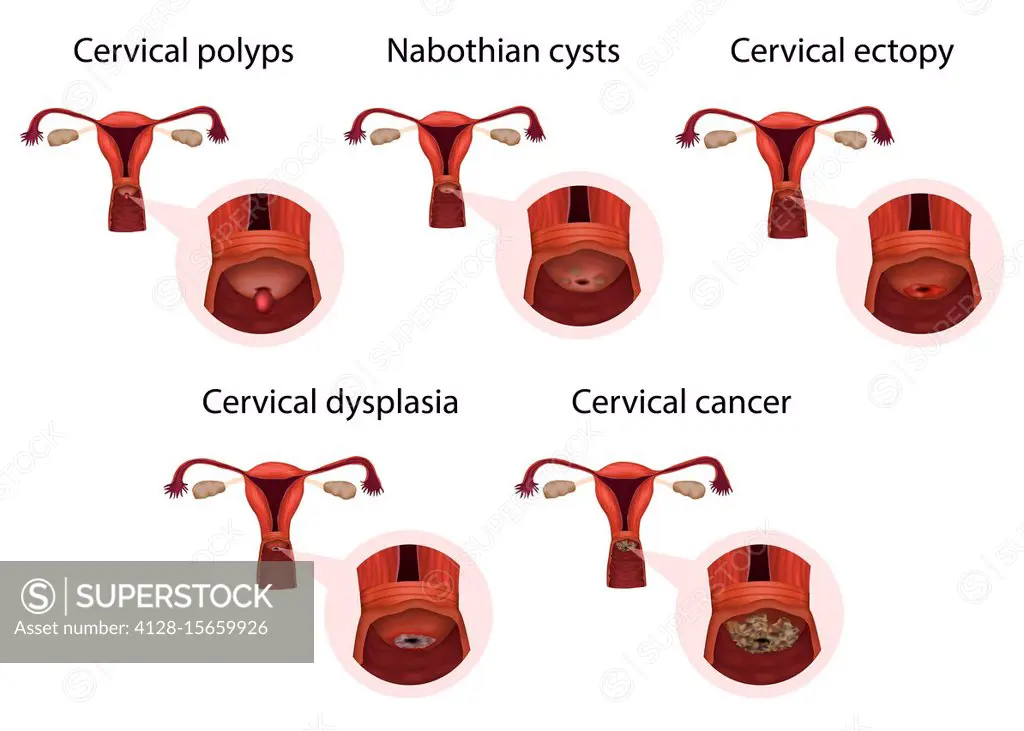 Cervical diseases, illustration