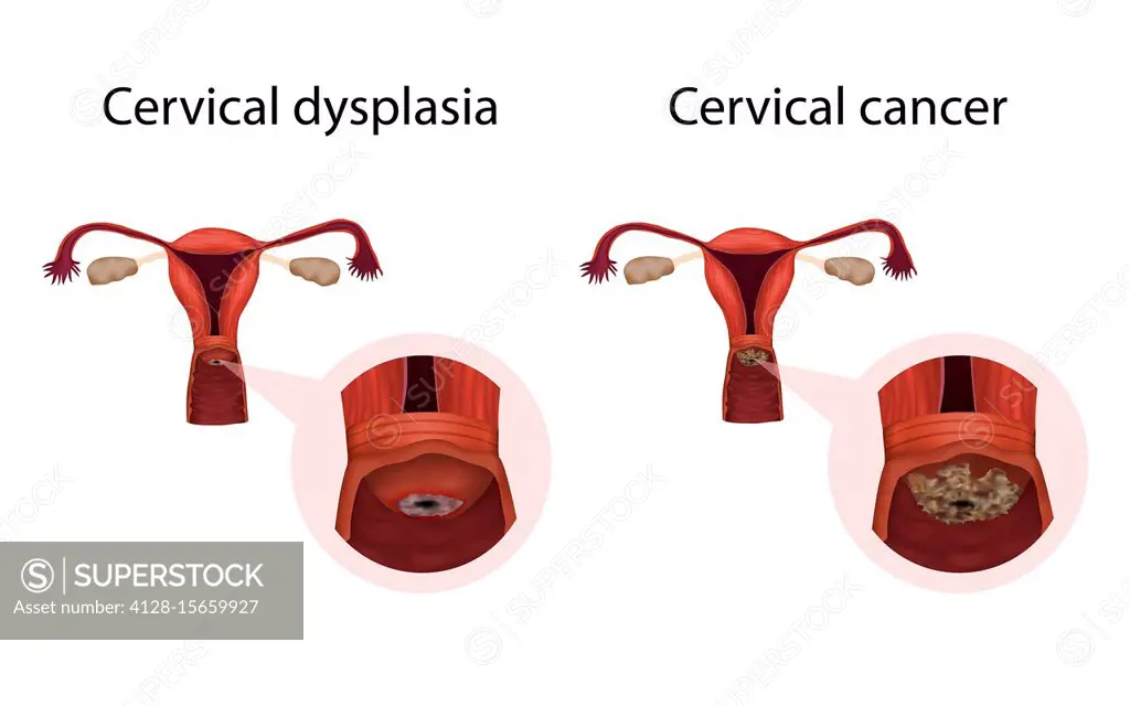 Cervical dysplasia and cervical cancer, illustration