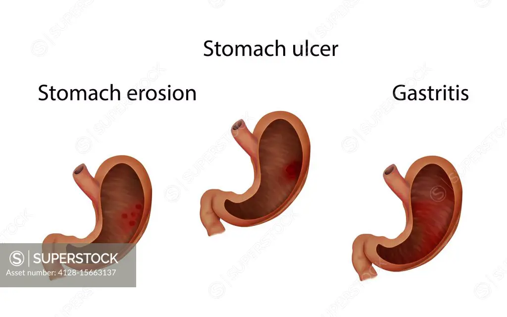 Gastritis, stomach ulcer and stomach erosion, illustration