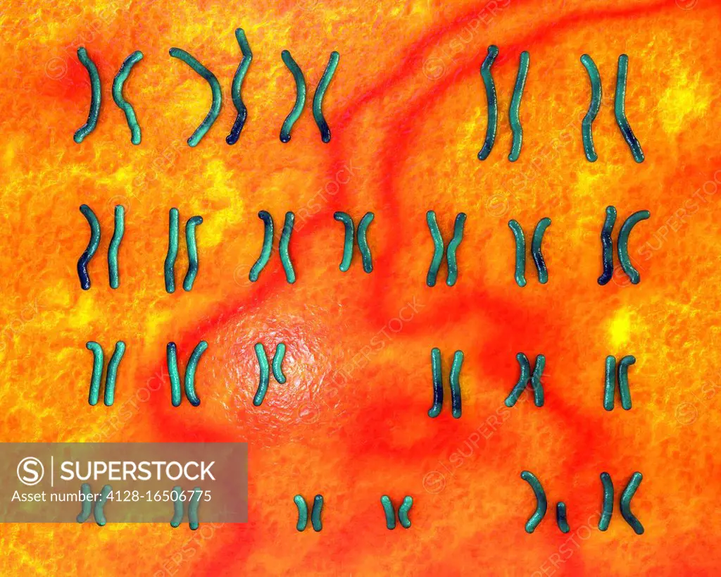 Karyotype of Prader-Willi syndrome, computer illustration. This is a genetic disorder caused by the deletion of a region on chromosome 15 inherited fr...