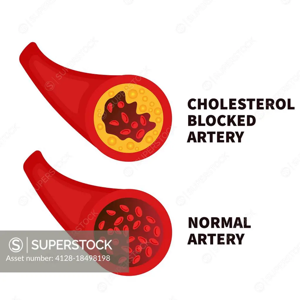 Hyperlipidaemia, conceptual illustration