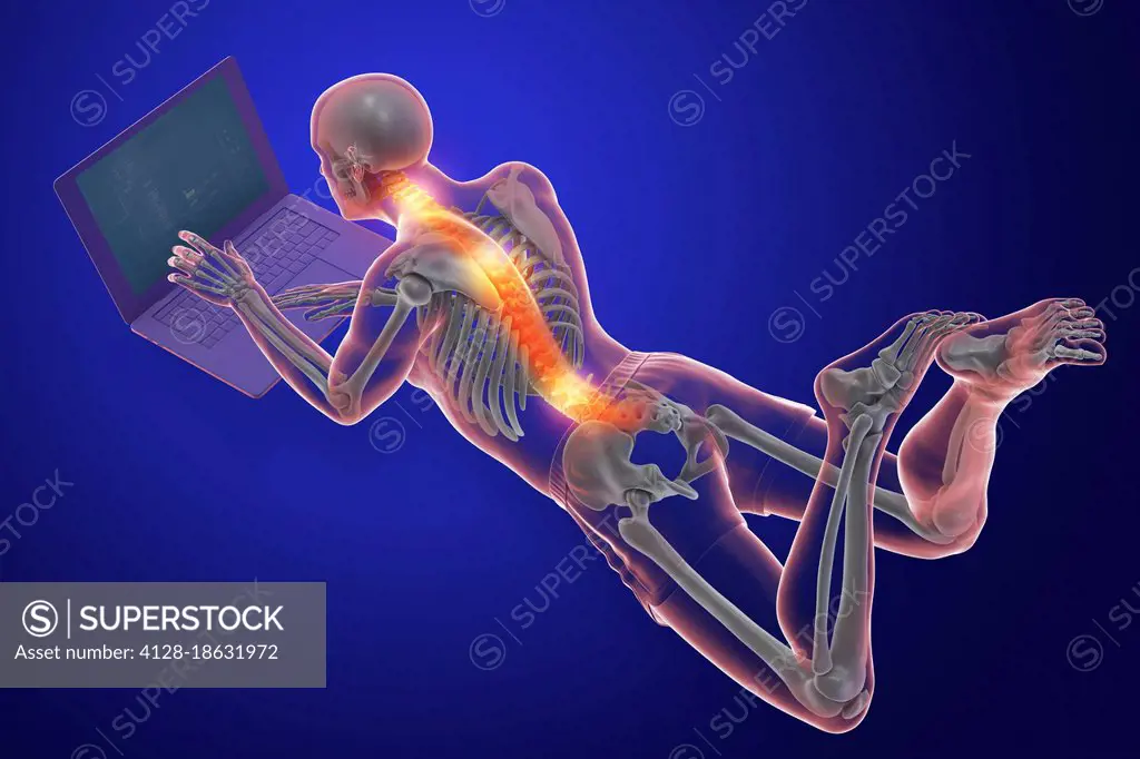 Bad posture whilst using laptop, illustration