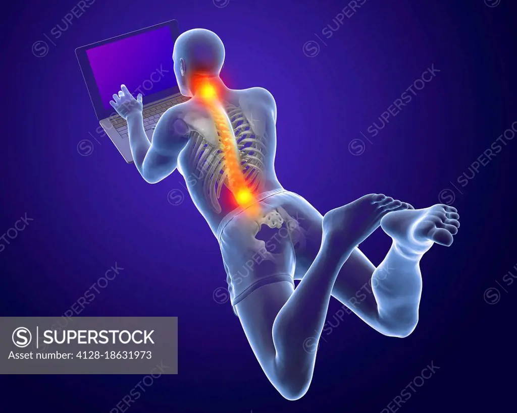 Bad posture whilst using laptop, illustration