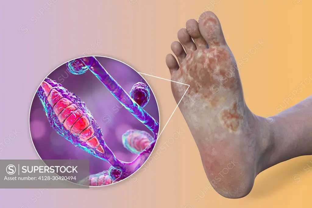 Microsporum canis infection of the foot, illustration