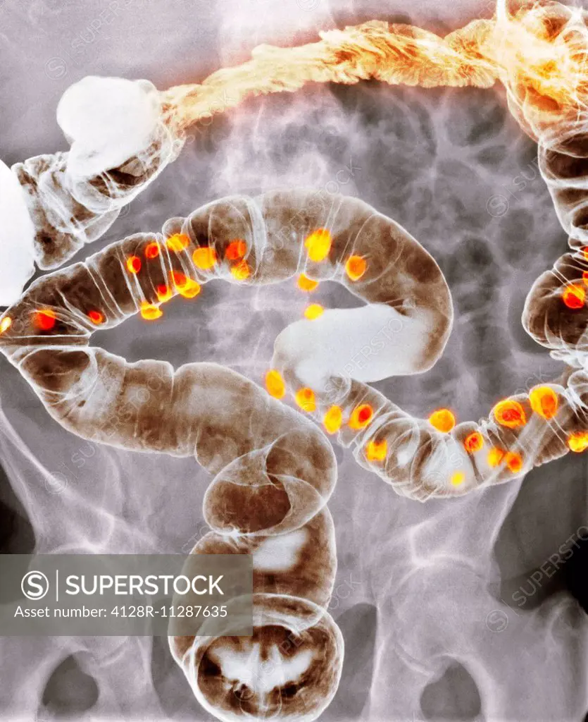 Diverticulitis. Coloured X-ray of the colon of a patient with diverticulitis. A diverticulum is a small pouch-like structure that protrudes out of wea...