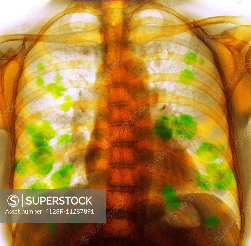 Secondary lung cancer. Coloured X-ray of the chest of a 52 year old female patient with metastatic (secondary) lung cancer (green).