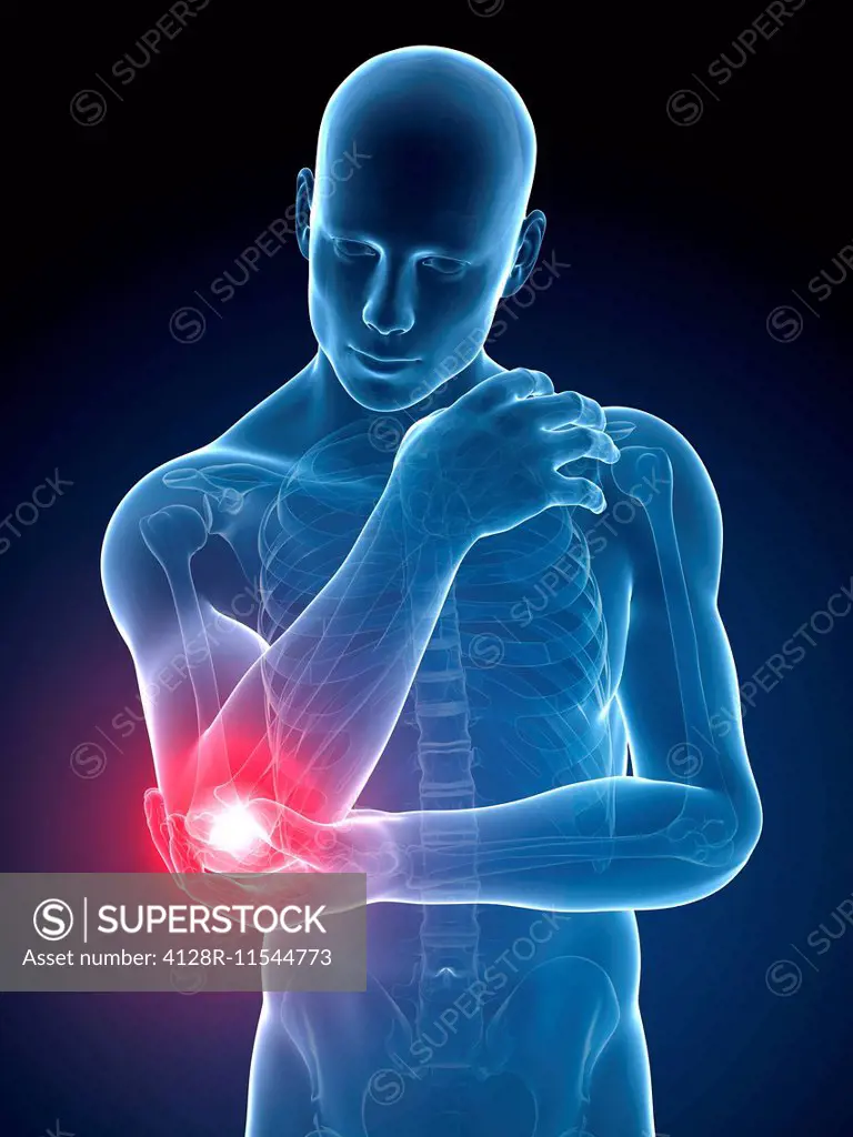 Human elbow pain, computer illustration.