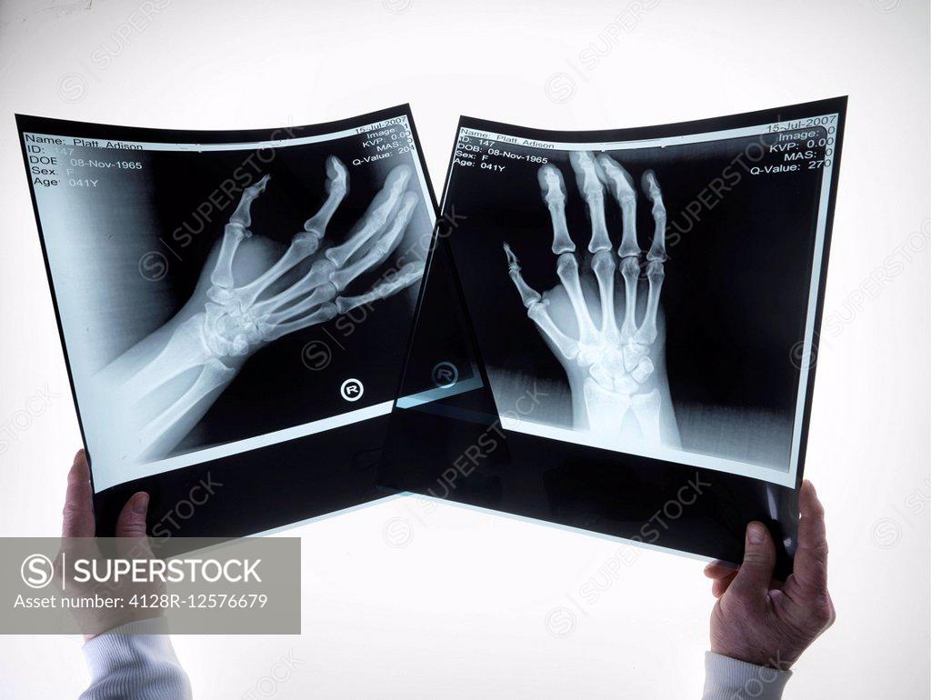 X-rays of hands. - SuperStock