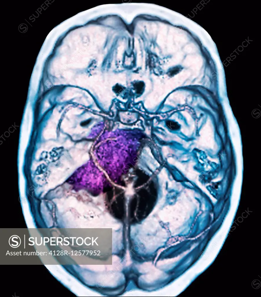 Benign brain tumour. Coloured computed tomography (CT) scan of the brain of a 48 year old patient with a meningioma (purple). This is a benign (non-ca...