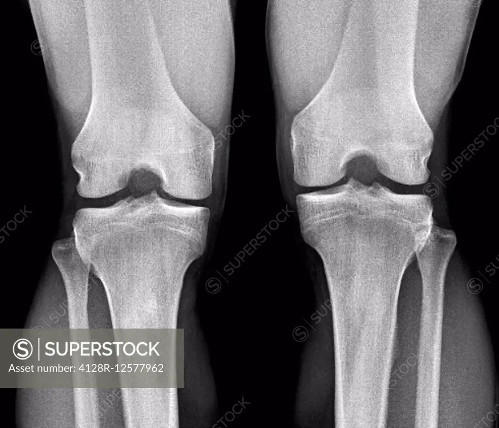 Normal knees. Frontal X-ray of the healthy knees of a 28 year old.