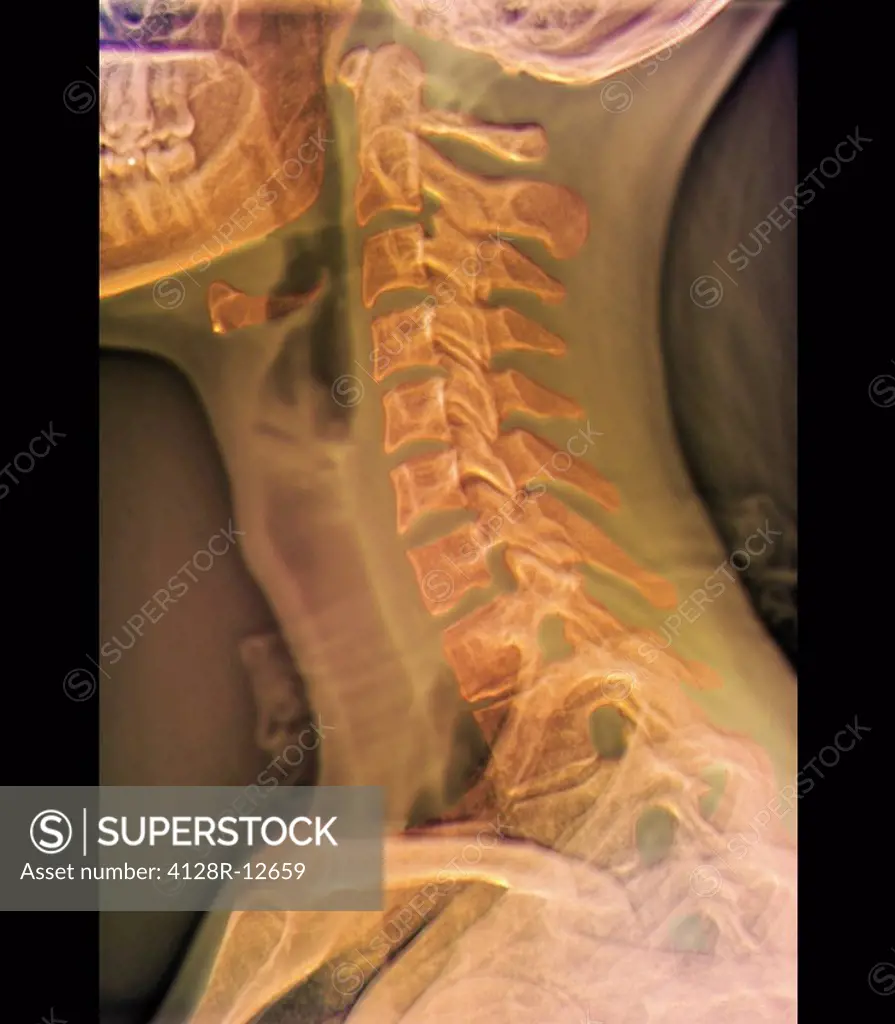 Normal neck. Coloured X_ray of the cervical spine of a 27 year old.