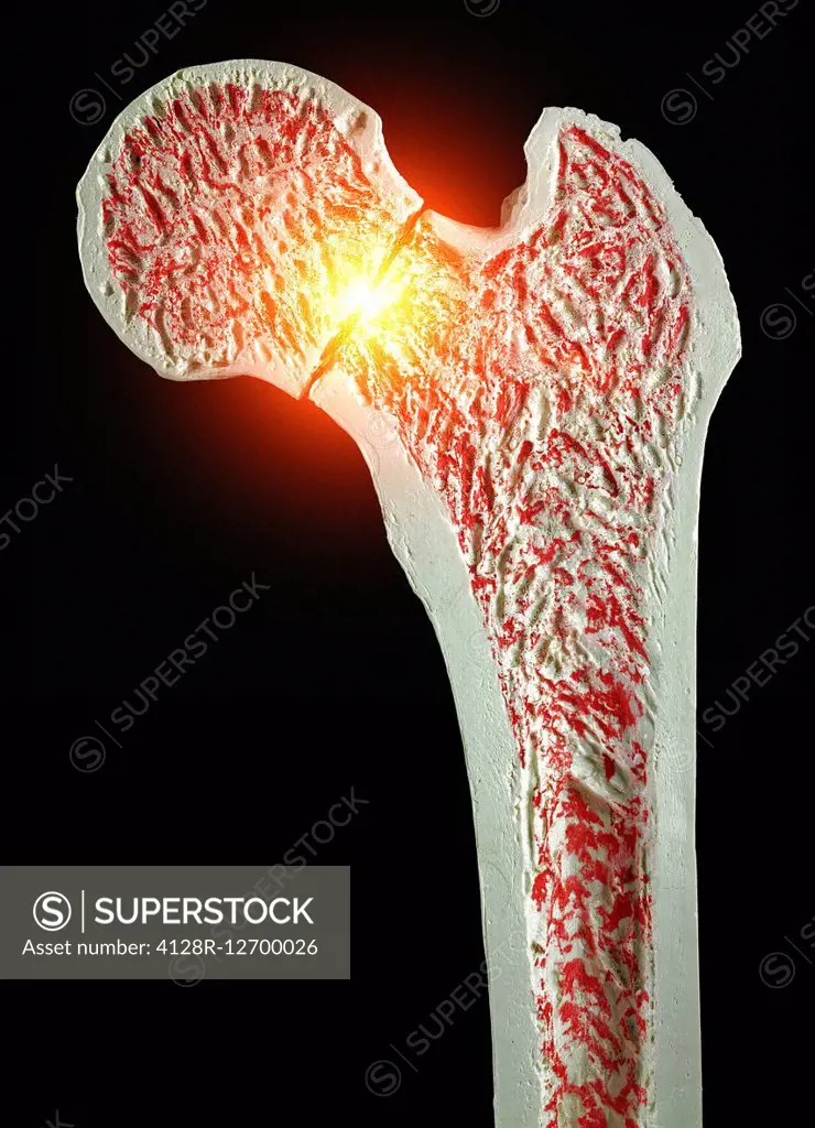 Cross section through an model of an fracture in the neck of the femur (thigh bone).