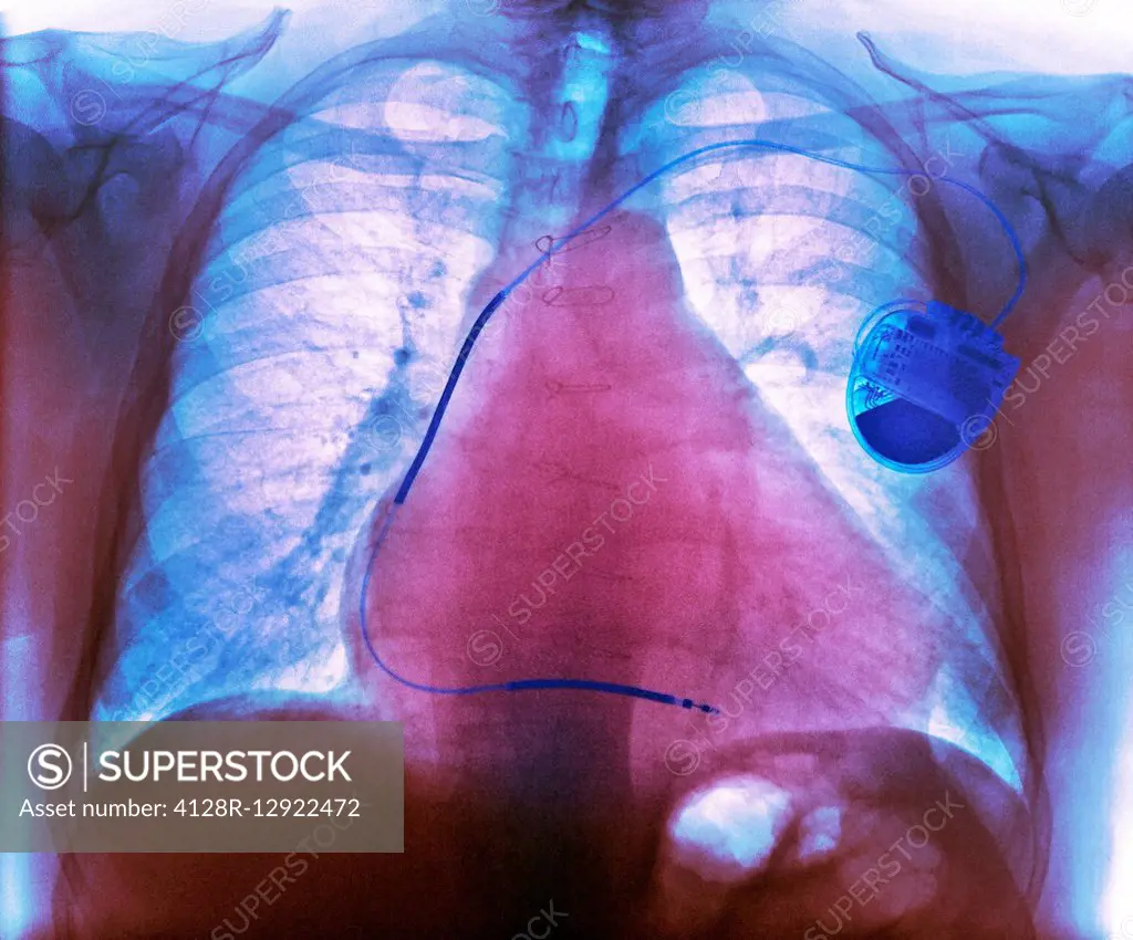 Pacemaker in heart disease, X-ray