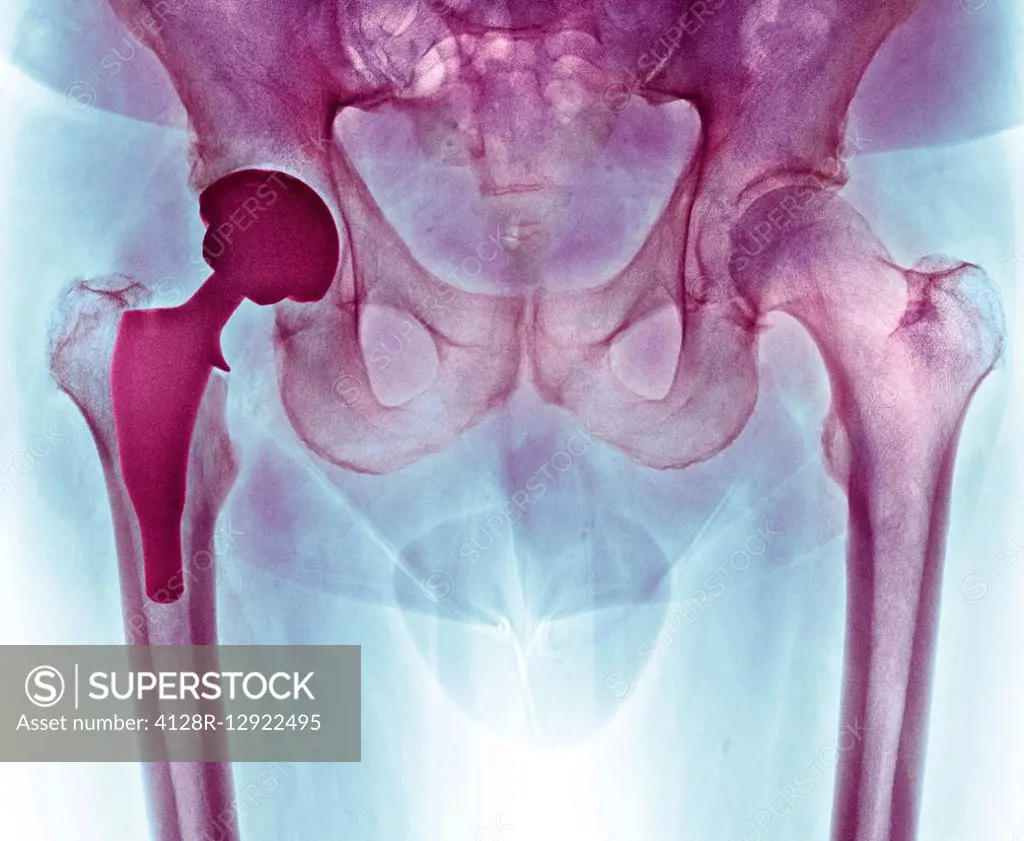 Total hip replacement, X-ray