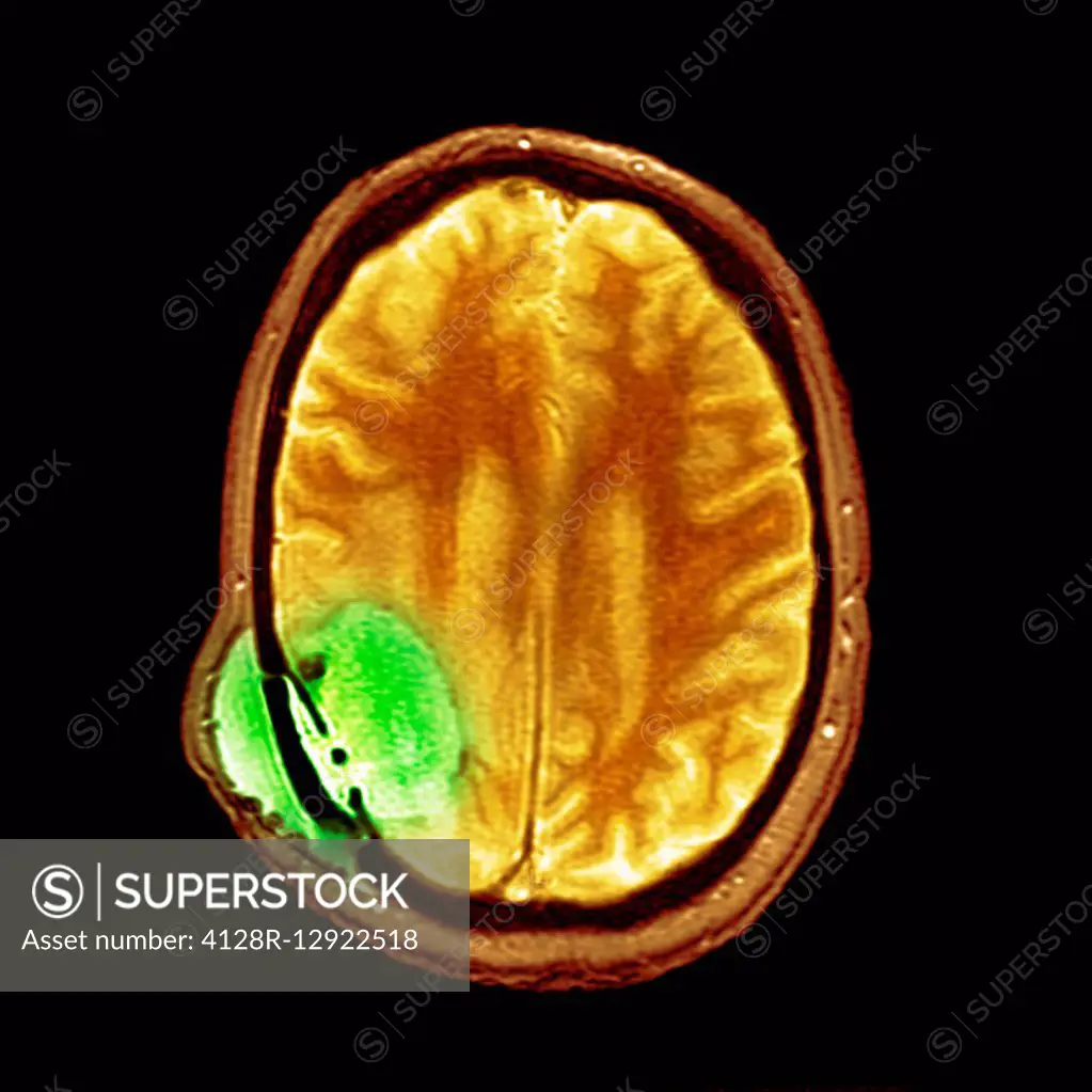 Brain cancer after surgery, MRI scan