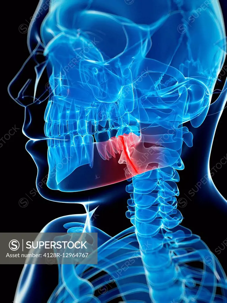 Broken jaw bone, Illustration