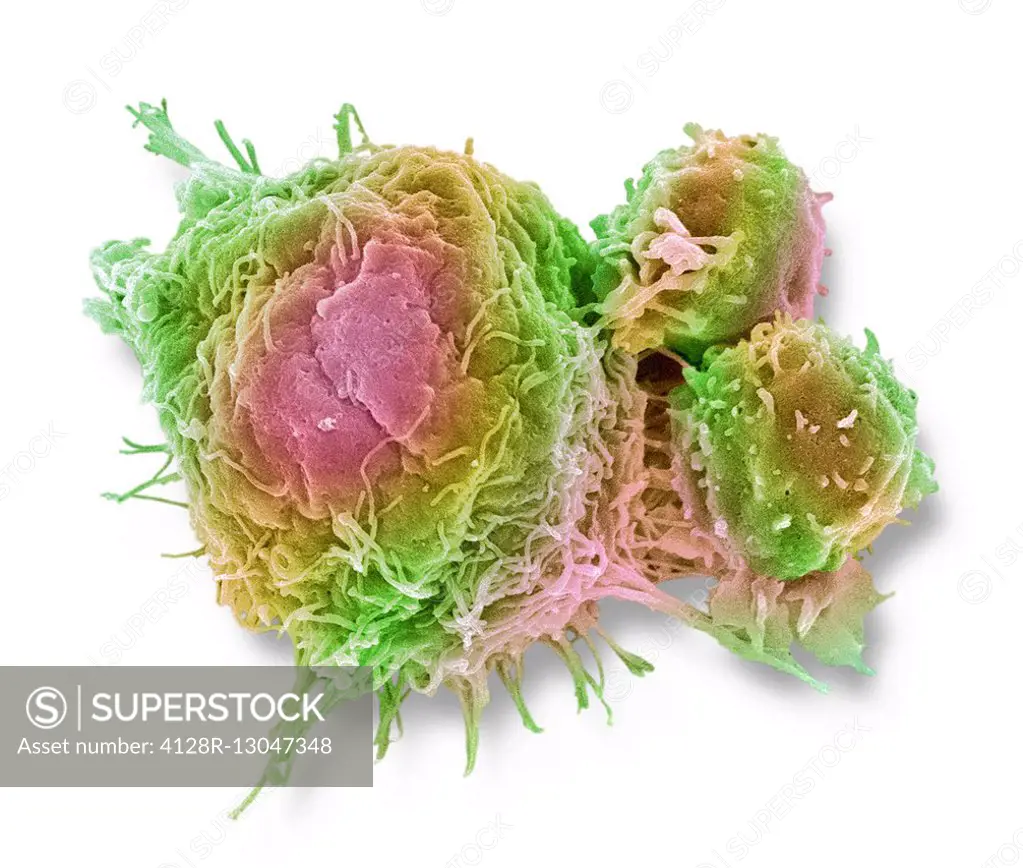 T lymphocytes and cancer cell. Coloured scanning electron micrograph (SEM) of T lymphocyte cells (smaller round cells) attached to a cancer cell. T ly...