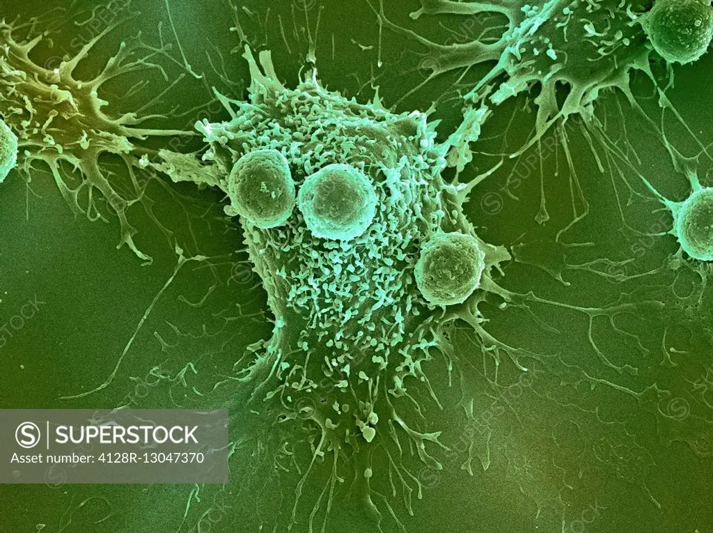 T lymphocytes and cancer cell. Coloured scanning electron micrograph (SEM) of T lymphocyte cells (smaller round cells) attached to a cancer cell. T ly...