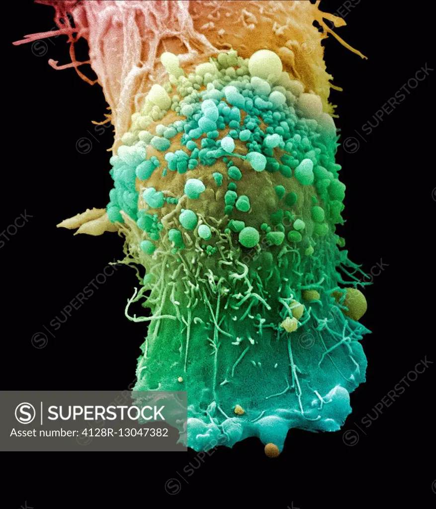 Skin cancer cell, coloured scanning electron micrograph (SEM). Cultured melanoma cell showing the numerous blebs and microvilli characteristic of canc...