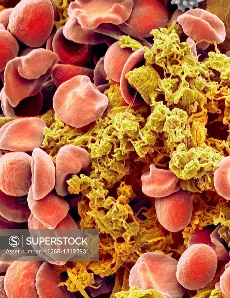 Red blood cells and platelets. Coloured scanning electon micrograph (SEM) of human erythrocytes (red blood cells) and a platelet aggregate (yellow). P...