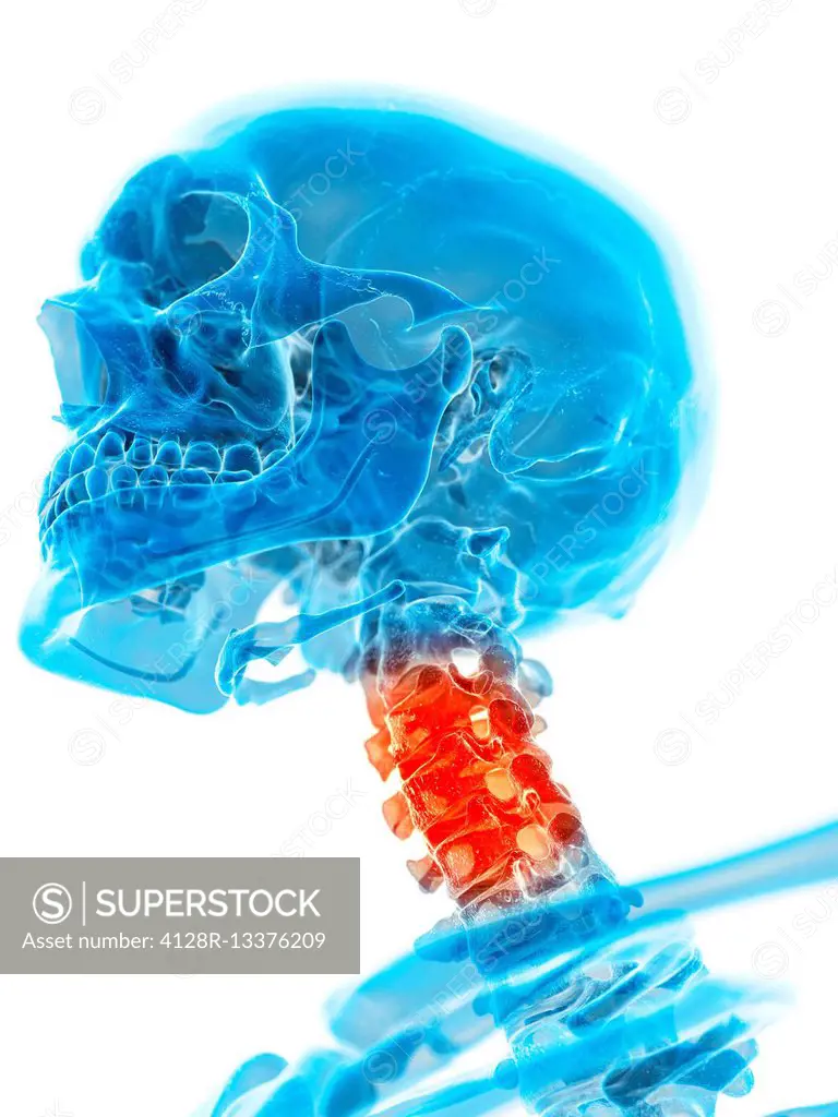 Human cervical spine pain