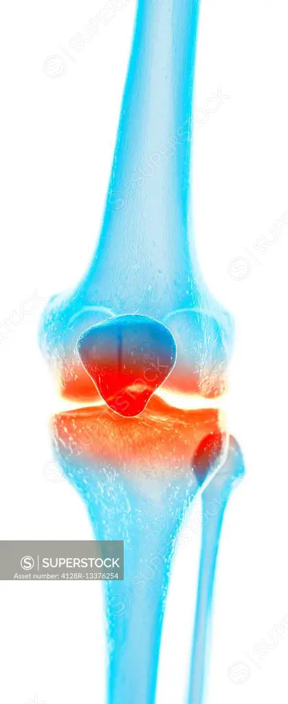 Human knee pain