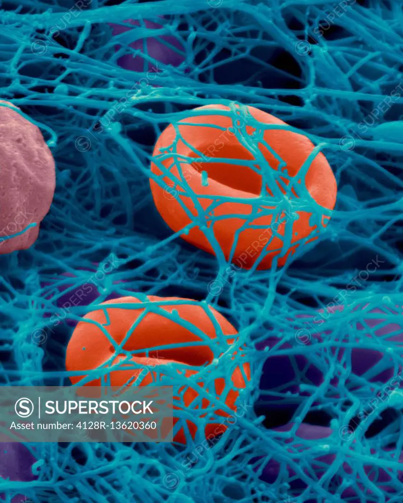 Human red blood cells trapped in a fibrin blood clot, coloured scanning electron micrograph (SEM). Human red blood cells trapped in a fibrin blood clo...