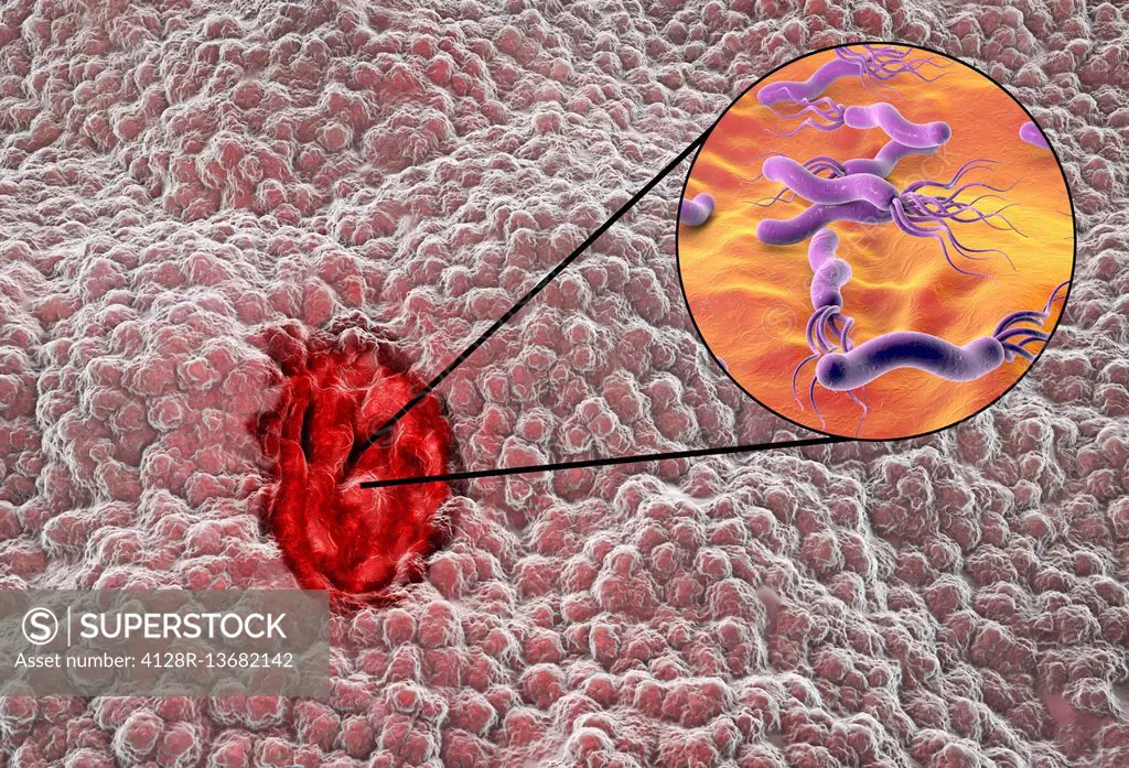 Illustration of a gastric (stomach) ulcer with a close-up view of Helicobacter pylori bacteria. Gastric, or peptic, ulcers are erosions of the mucosal...