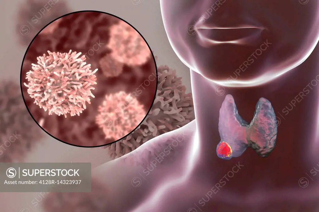 Thyroid gland cancer, illustration