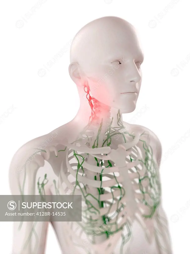 Swollen lymph nodes in the neck, computer artwork.